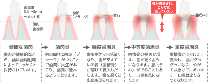 歯周病の進行