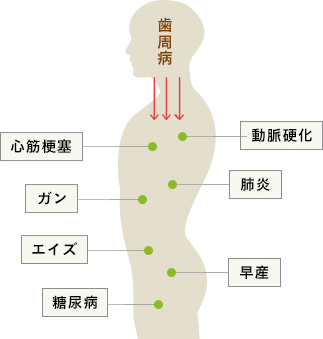 歯周病が全身に与える影響