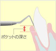 ポケット検査