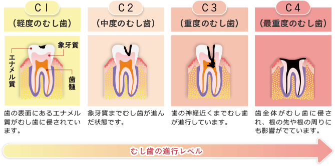 むし歯の進行