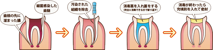 根管治療の流れ