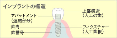 インプラントの構造